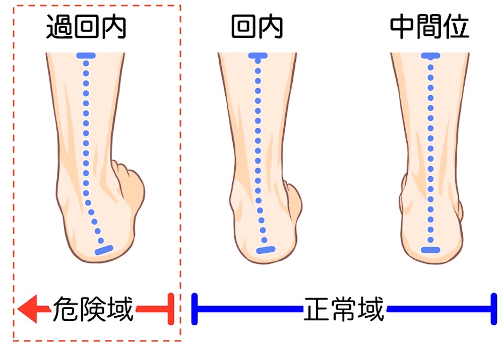回内足イラスト危険領域